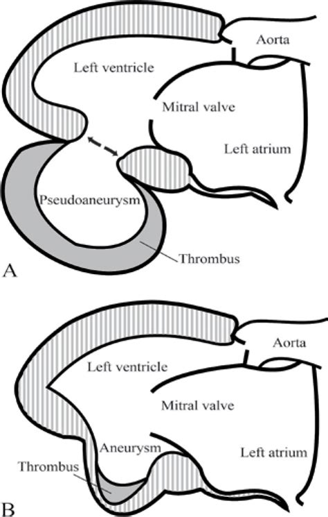 lv apical aneurysm vs pseudoaneurysm|pseudoaneurysm vs true aneurysm echo.